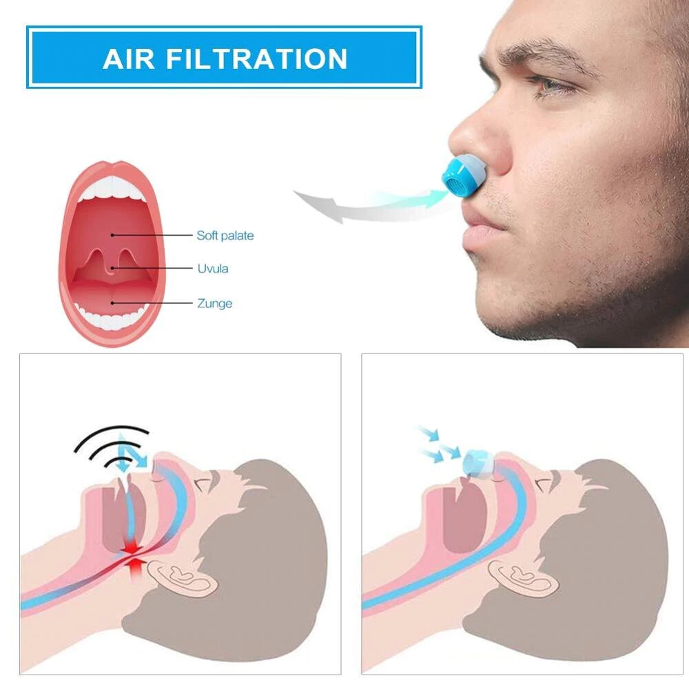 Glevato | Anti-Snoring Device | Tubeless, Maskless Micro-CPAP