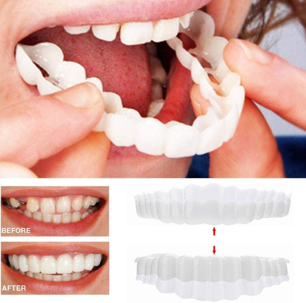 Glevato | On Smile Veneers (Upper and Lower Jaw included)