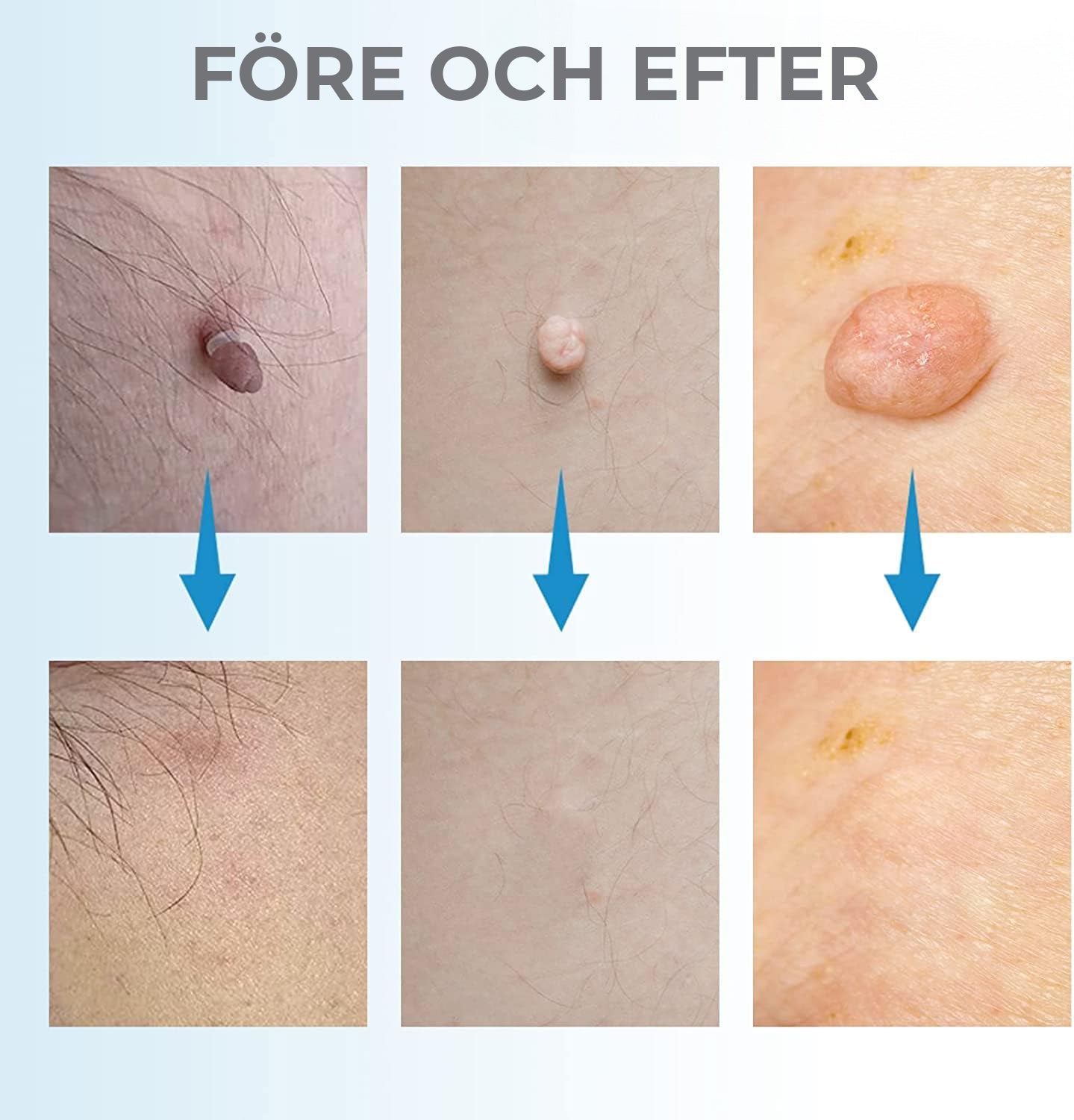 Liver Spot Removal - Removal of Moles